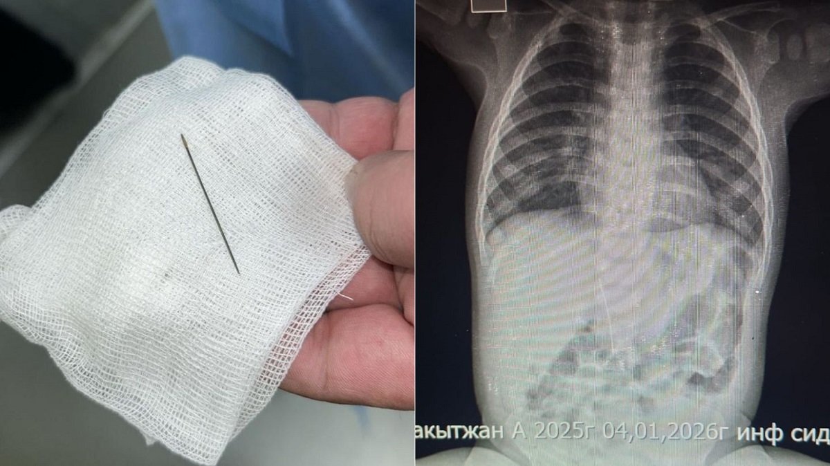 Сегіз айлық сәбидің іш қуысынан ине табылды