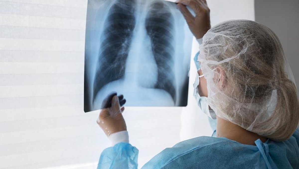 Еліміз туберкулезді емдеу тиімділігі бойынша жоғары нәтижеге ие