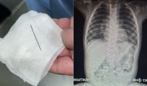 Сегіз айлық сәбидің іш қуысынан ине табылды