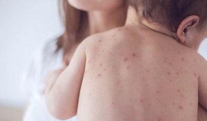 Екпе жоқ болса, ем де жоқ: Астанада балаларды ауруханаға жатқызу тәртібі өзгерді