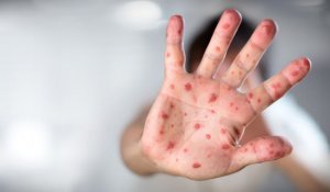 Екпе алмаған балалар мектеп пен балабақшаға уақытша жіберілмейді