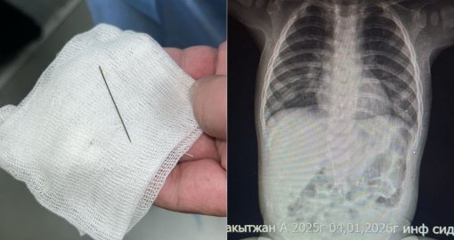 Сегіз айлық сәбидің іш қуысынан ине табылды